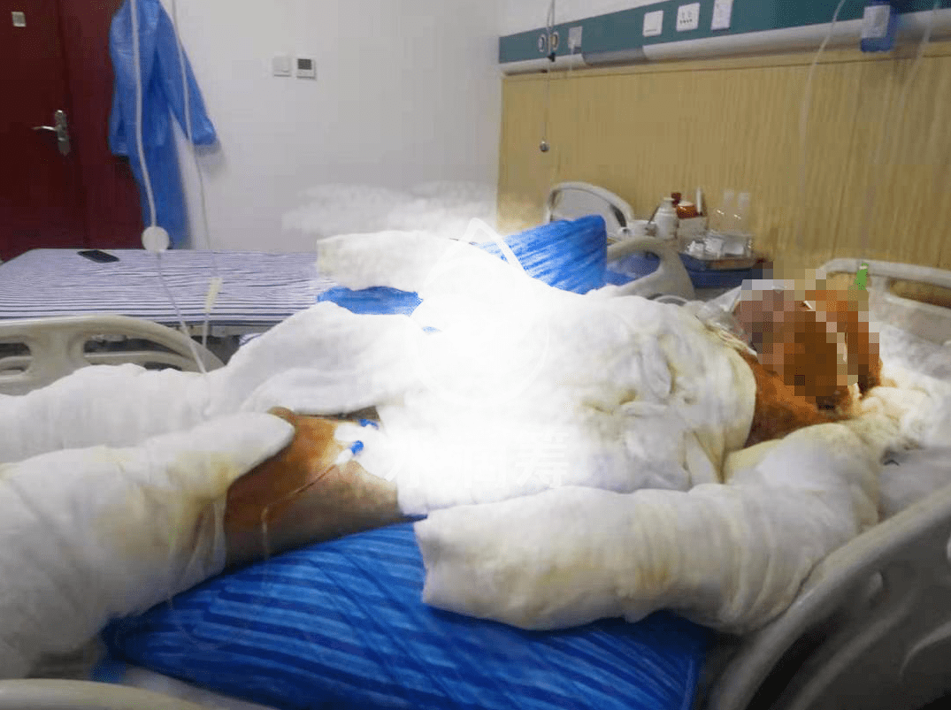 昨日萍鄉(xiāng)一住戶家中發(fā)生煤氣爆炸，全身90%燒傷