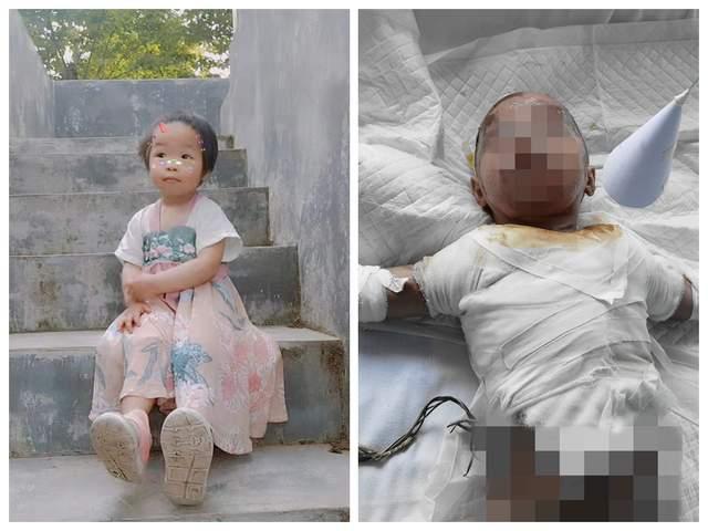 這個2歲的女孩被燒得面目全非，她的父親很后悔，只因一個小小的錯誤